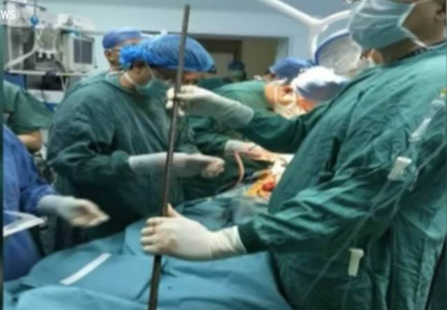 بالفيديو.. رجل ينجو من الموت بعد اختراق «سيخ حديد» جسده