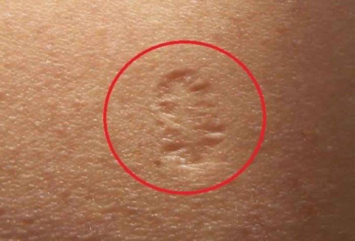 ماذا تعني الندبة الصغيرة الموجودة على أعلى الذراع اليسرى؟