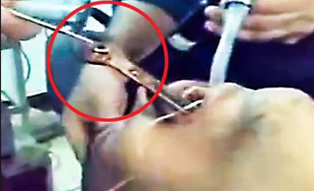 بالفيديو: أطباء يستخرجون مفتاحاً من بلعوم أحد الأشخاص!