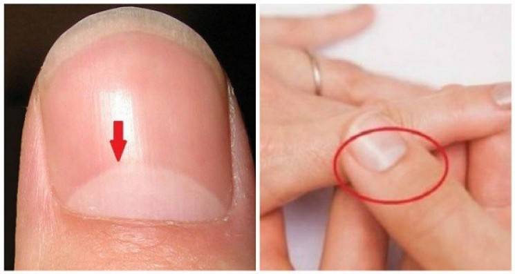 هذه الدائرة على ظفركم تخبر أشياء كثيرة عن صحتكم !