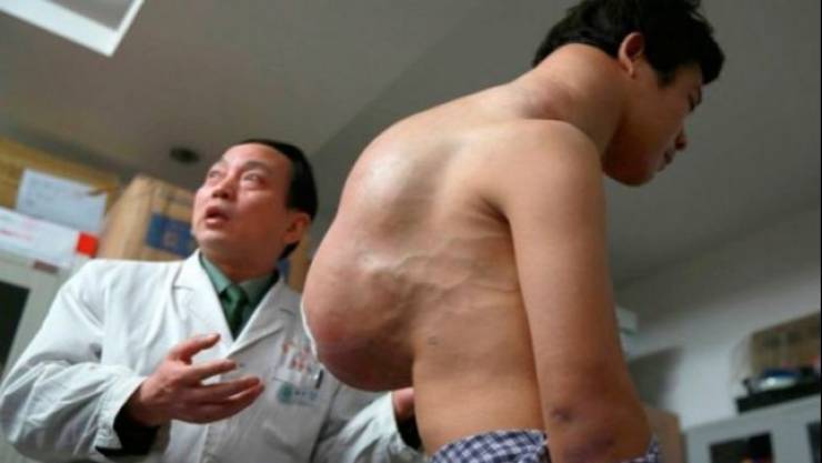 صورة:  بدأت رقبته بالتضخم منذ ١٠ اعوام فقرر الذهاب للطبيب..ماذا حصل؟