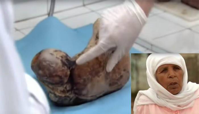 بالفيديو: ظن الأطباء أنه ورم  لكن ما وجدوه في جسم زهرة صدم الكل!