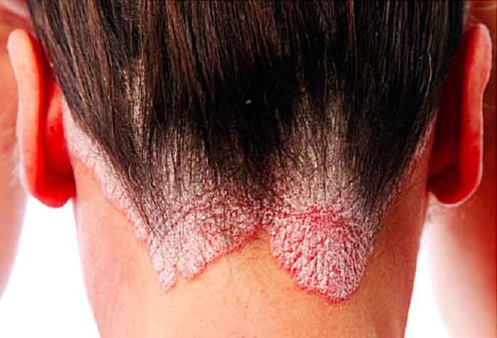 7 علاجات فعّالة وطبيعية لمرض الصدفيّة