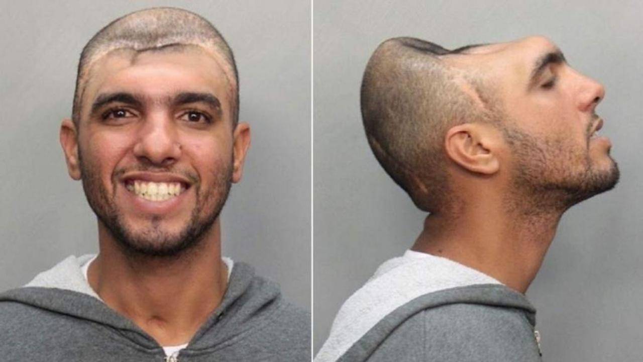 صورة بدون تعديلات.. لشاب يعيش طبيعيا بنصف رأس!