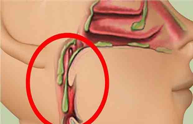 تجنبوا هذه الأطعمة الأربعة للتخلص من البلغم في الحنجرة