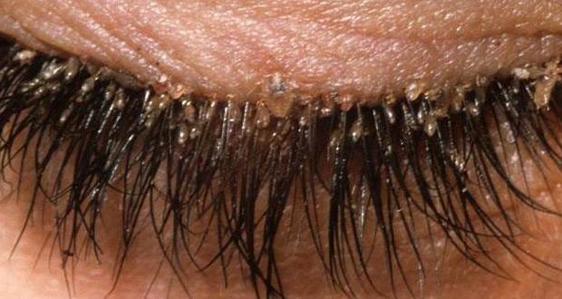 كلنا لدينا عث ( mites ) في رموشنا فكيف نستطيع التخلص منه