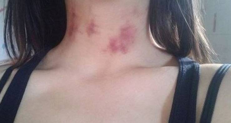 ما لا تعرفه عن البقع الحمراء ما بعد العلاقة الحميمة!
