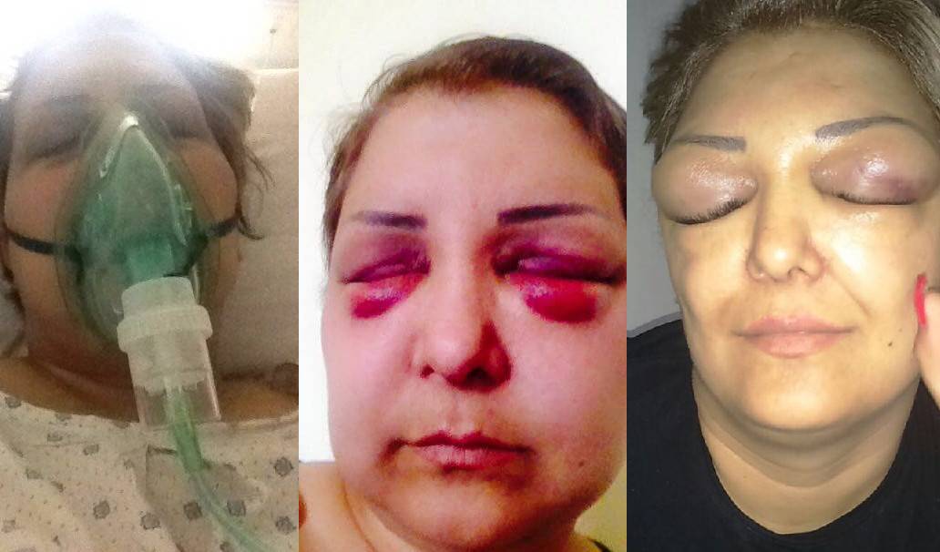 إبرة بوتوكس أفقدتها بصرها!