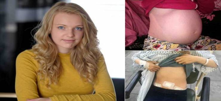 صور: استمر بطنها في الانتفاخ حتى أصبح بحجم كرة السلة.. والسبب!