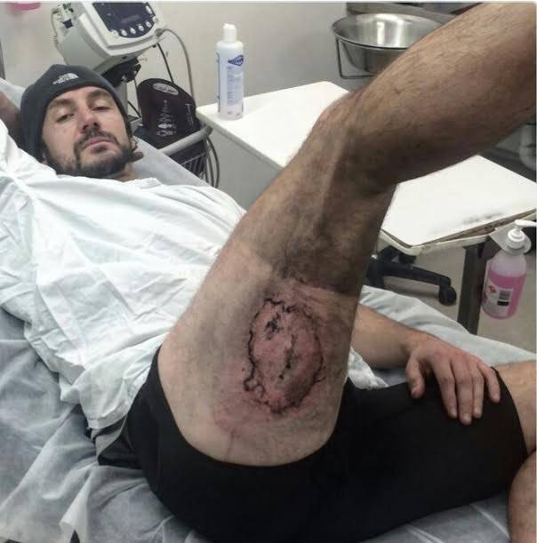 بالصور: انفجرت بطارية هاتف “آيفون 6“ في جيبه وهذه النتيجة!