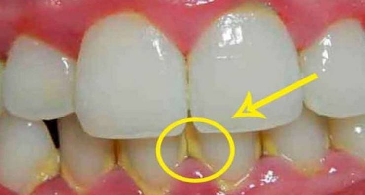 كيف تزيل رواسب الأسنان بـ5 دقائق فقط ودون الذهاب إلى الطبيب!