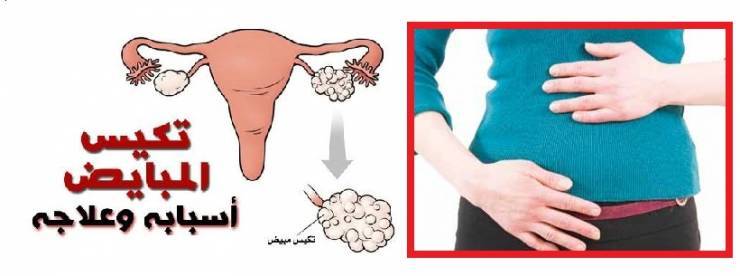حل تكيس المبايض للفتيات غير المتزوجات