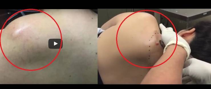 ‏فيديو صادم‬: ماذا أخرجت هذه الطبيبة من كتف هذا الرجل؟