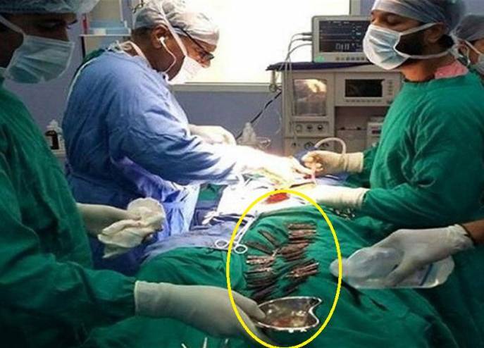 دخل إلى المستشفى بحالة طارئة.. وما وجدوه في معدته أدهشهم!