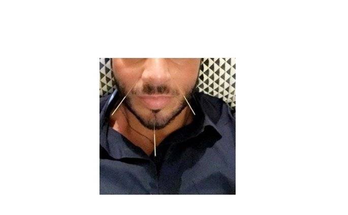 لأصحاب القلوب القوية.. صورة مذيع لبناني خلال وخز وجهه بالأبر