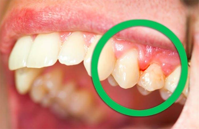 6 علاجات طبيعية لمعالجة ألم اللثّة