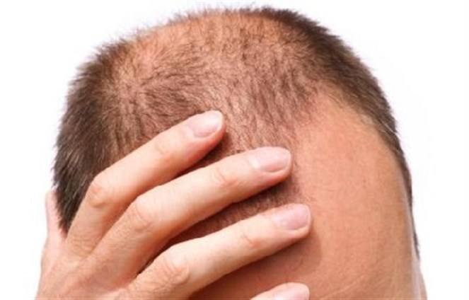 ماذا يحدث للأصلع بعد زراعة الشعر؟