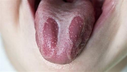 4 طرق تخلصك من فطريات الفم نهائيا