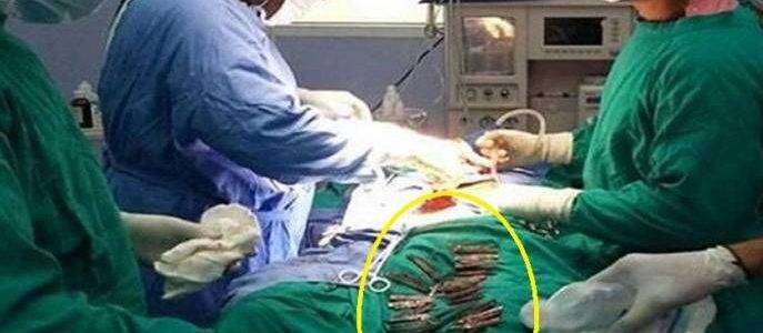 دخل إلى المستشفى بحالة طارئة.. وما وجدوه في معدته أدهشهم !!
