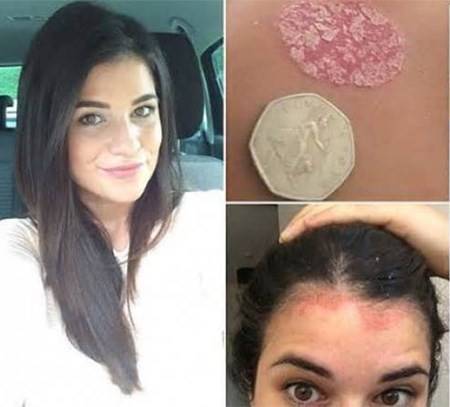 بالصور: وجدوا بقعًا على جسدها فأخرجوها من المسبح ليكتشفوا أنها مصابة بـ..!!