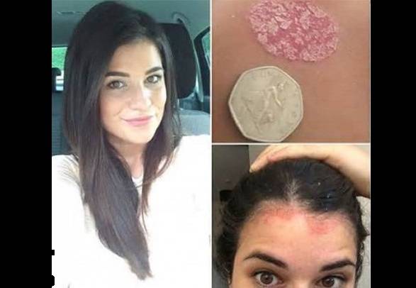 وجدوا هذه البقع على جسدها فأخرجوها من بركة السباحة ليكتشفوا أنها مصابة بـ..!