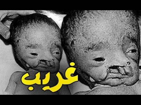 فيديو صادم لحقيقة الطفل الذي تحول إلى فيل من عامه الثاني!