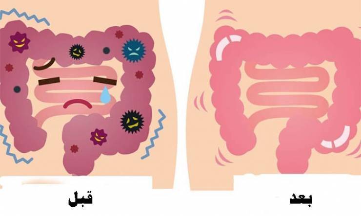 هكذا تتخلصون من الفضلات والسموم في القولون!