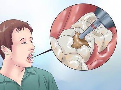خليط طبيعي يقضي على ألم الأسنان في دقيقة واحدة فقط!