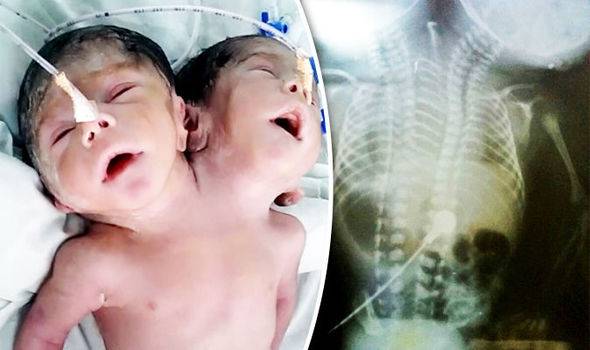 بالفيديو:  طفل وُلِدَ برأسين