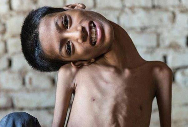 بالصور- كيف  أصبح طفل "الرقبة الملتوية" بعد اجراء عملية له؟