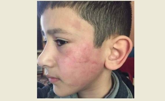 عنفٌ مدرسيٌ جديد في لبنان.. هذه قصّة الطفل "حيدر"