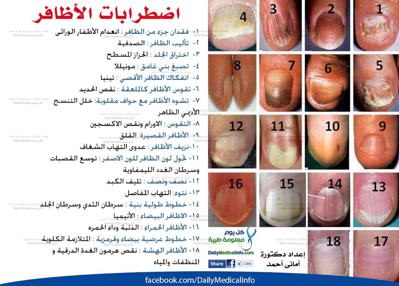 أظافرك عنوان صحتك.. هل تعاني من هذه الأمراض؟