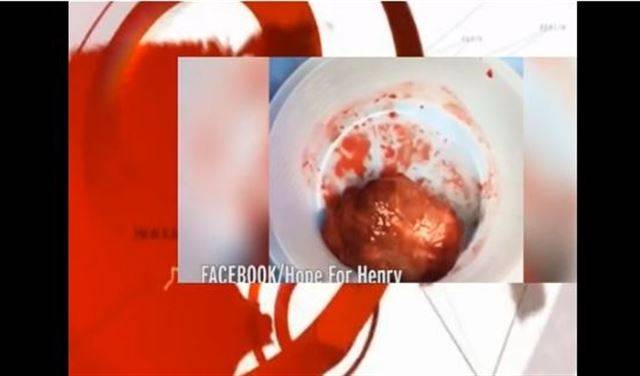 بالفيديو.. قلب رضيع ينبض خارج جسده أثناء عملية جراحية