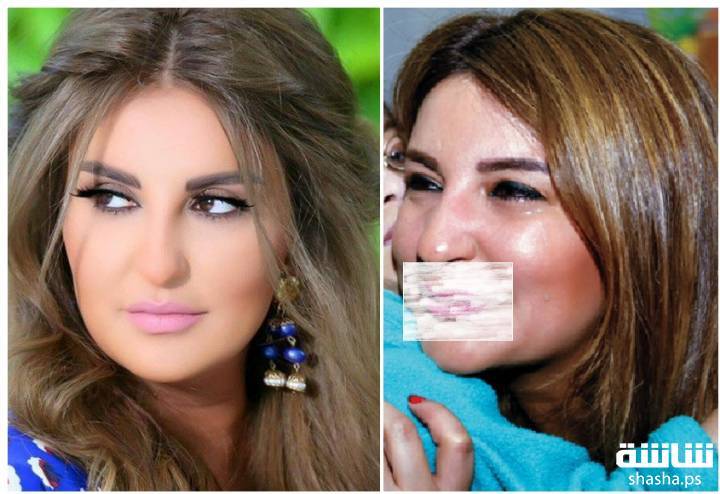 بالصور: ماذا حصل بشفاه شذى حسّون؟