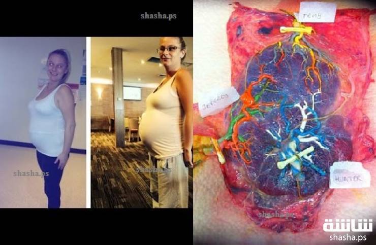 شاهد أم التقطت صورة لبطنها.. عندما رآها الأطبّاء أصيبوا بالصدمة!
