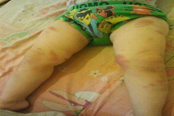 آثار كدمات على جسد طفل تثير قضية تعنيف داخل حضانة؟!