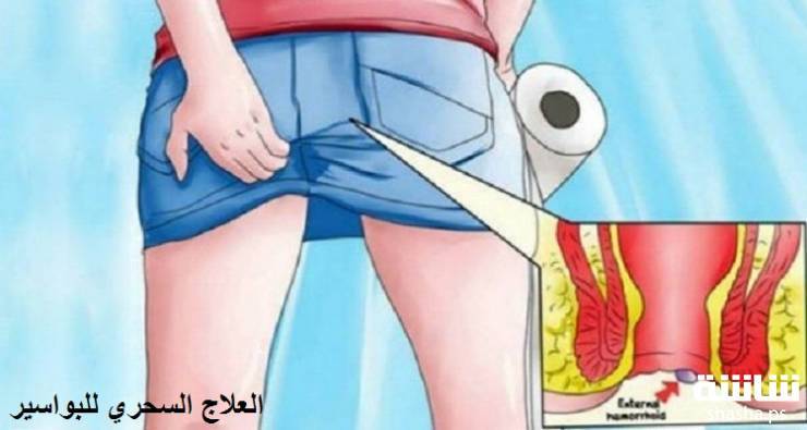 قولوا وداعاً للبواسير والحكة بهذه الحيلة الطبيعية السريعة!