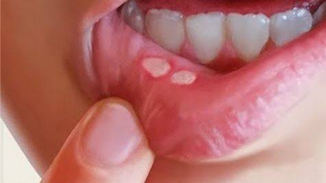 4 طرق طبيعيّة تخلّصك من تقرّحات الفم فوراً
