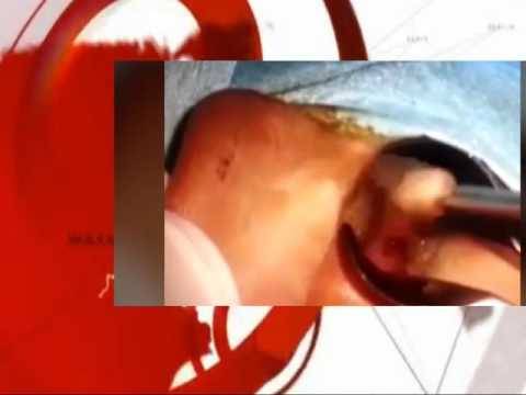 بالفيديو.. ماذا كان يعيش في أذن هذا الصبي لا يصدق