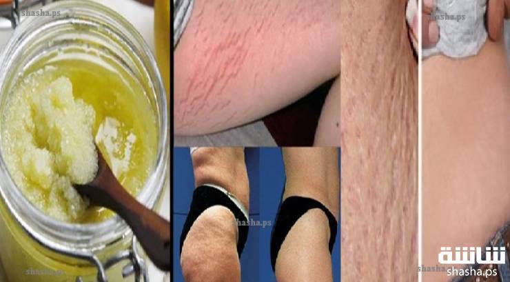 وصفة قوية للتخلص من علامات تمدد الجلد!