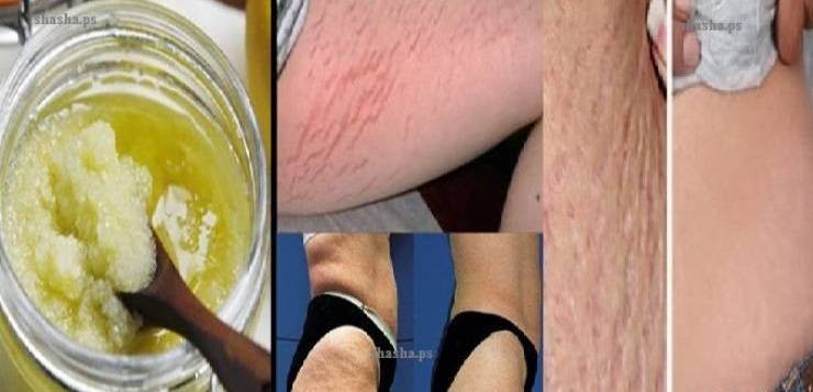 وصفة فعالة للتخلص من علامات تمدد الجلد!