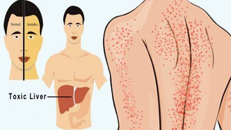 خطير جداً.. هذه العلامات تؤكد إصابتكم بإلتهاب الكبد