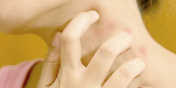 إذا احمرّ جلدك وتقشر.. إحذر