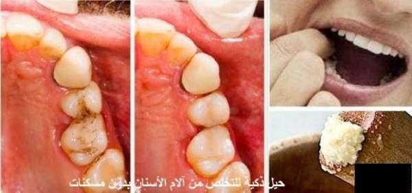 حيل ذكية للتخلص من آلام الأسنان فوراً!