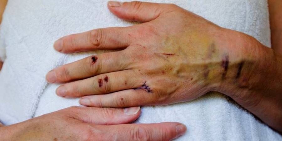 لماذا يتأخر شفاء الجروح مع التقدم ب السن ؟