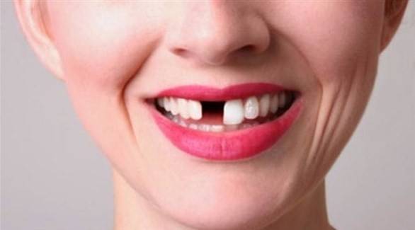 ماذا تفعل عندما تفقد أحد أسنانك؟