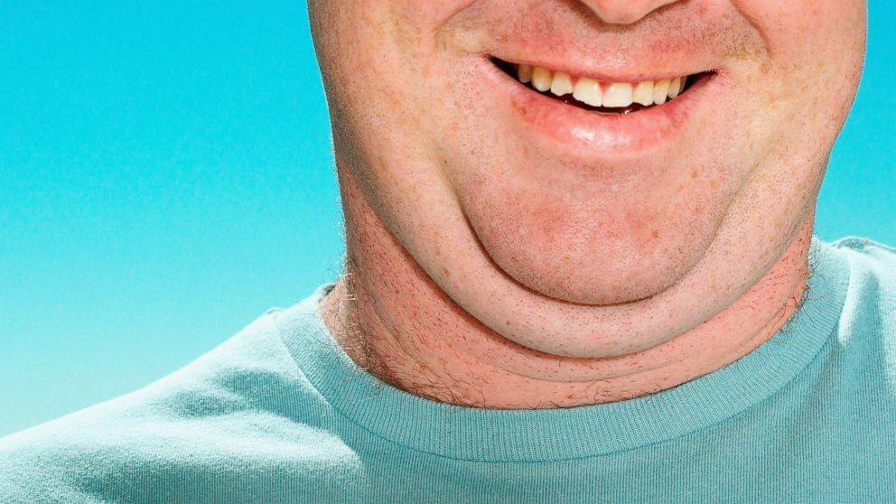 لماذا يزداد حجم الذقن لدى البعض؟