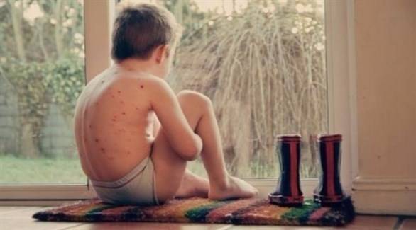 علاجات منزلية فعّالة لعلامات جدري الماء