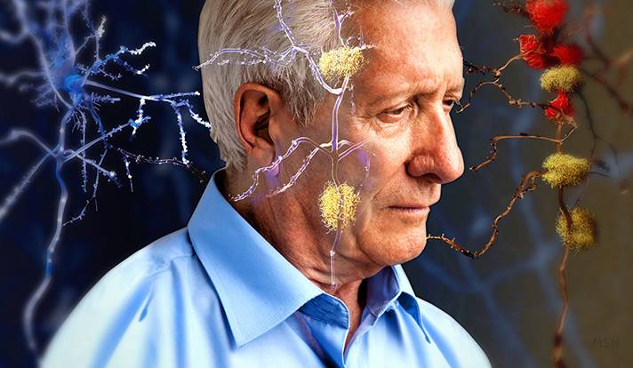 بهذه الإجراءات تقلل مخاطر الإصابة بالزهايمر