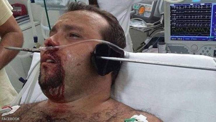 سهم يخترق رأس رجل وبقي على قيد الحياة!